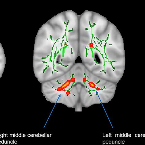 Brain White Matter Wm Microstructural Changes In Eg Patients Compared