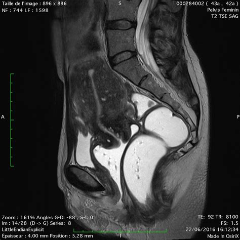 Le diagnostic de l endométriose IFEM Endo