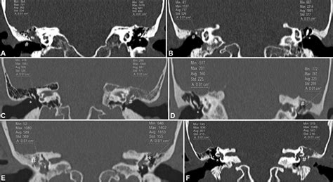 Coronal HRCT scans of the temporal bone without contrast material ...