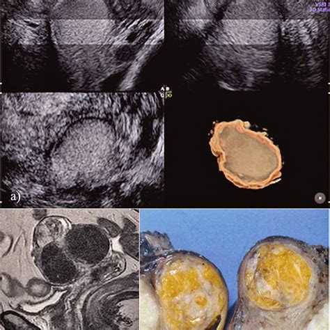 (PDF) Three-dimensional ultrasound radiance mode imaging of a uterine ...