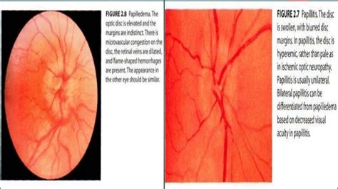 Papilledema vs papillitis with notes timothy zagada