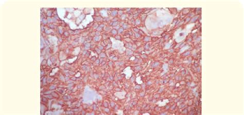 More Intense Staining Of Glut In Oral Squamous Cell Carcinoma From