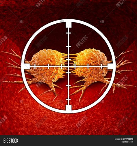 Treatment Malignant Image & Photo (Free Trial) | Bigstock