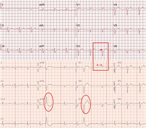 Immune Checkpoint Inhibitor Myocarditis Pathophysiological