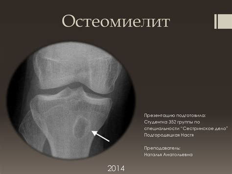 Остеомиелит. Острый гематогенный остеомиелит - презентация онлайн