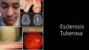 Día Internacional de la Esclerosis Tuberosa Salud 24 Enfermería a