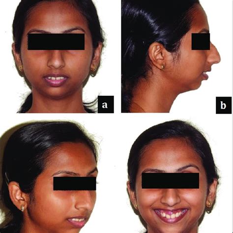 Pretreatment Intraoral Photographs A Right Buccal View B Anterior