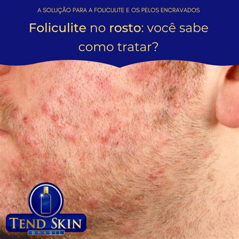 Foliculite No Rosto Voc Sabe Como Tratar