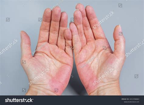 Bilateral Palmar Erythema Red Hands Palm Stock Photo 2213706863