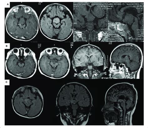 Magnetic Resonance Imaging Scans Of The Patient At Different Ages