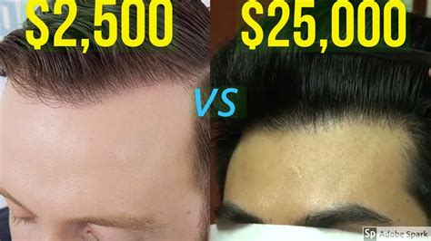 2500 Hair Transplant Vs 25000 Hair Transplant Youtube