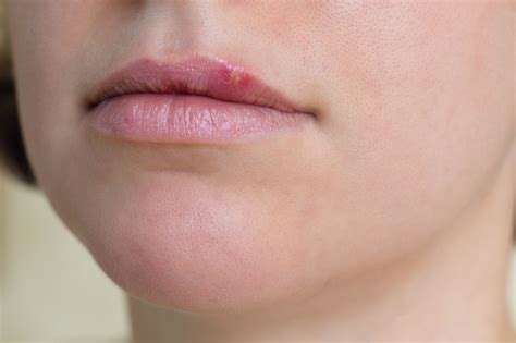 What Causes Cold Sores On Lips And How To Prevent Them