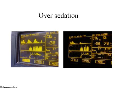 Capnograms During Procedural Sedation Capnography