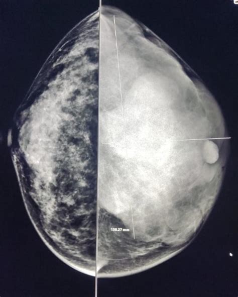 Tumor Phyllodes Mama Cistosarcoma Filodes Ocronos Editorial