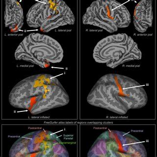 Cortical thinning in OSA. Regions showing cortical thinning in OSA... | Download Scientific Diagram