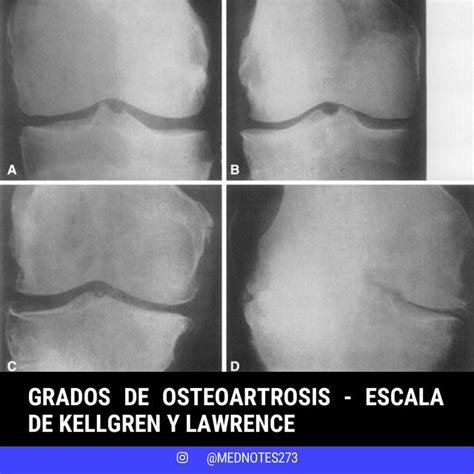 GRADOS DE OSTEOARTROSIS REUMATOLOGÍA Med Ciencia uDocz