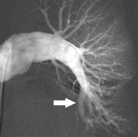 Ct Angiography Of Pulmonary Embolism Diagnostic Criteria And Causes Of Misdiagnosis Radiographics