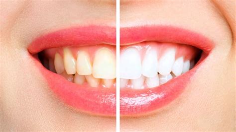 Astuces Compl Tement Naturelles Pour Avoir Des Dents Blanches Tuxboard