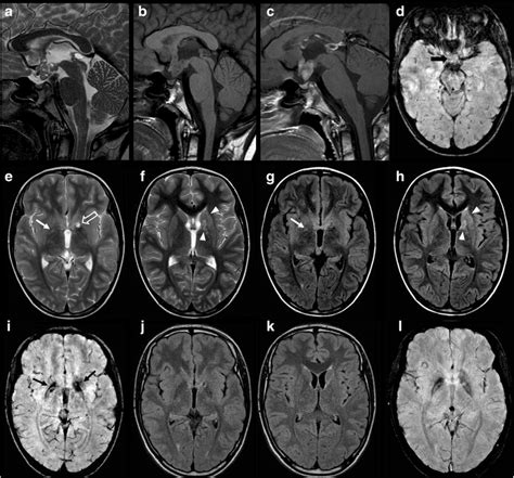 Germinoma with synchronous involvement of midline and off-midline ...