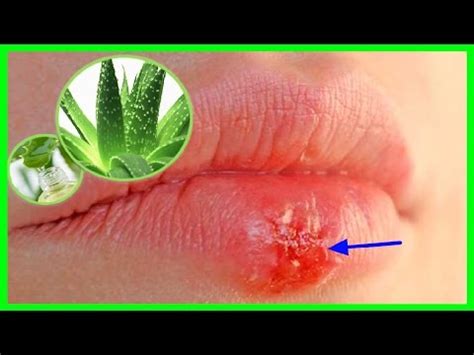 Como Eliminar Herpes Labial Remedio con Sábila Aloe Vera Remedios