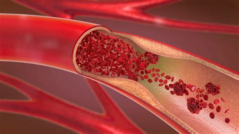 How To Prevent Blood Clots And Why They Happen Woman Home