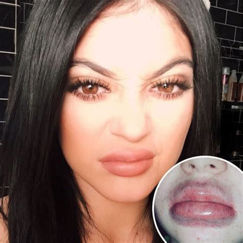 Kylie Jenner Lip Challenge Produces Terrifying Results—Teens, This Is Not the Way to Plump Your ...