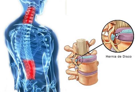 H Rnia Discal Sintomas E Tratamento Inspire Sa De