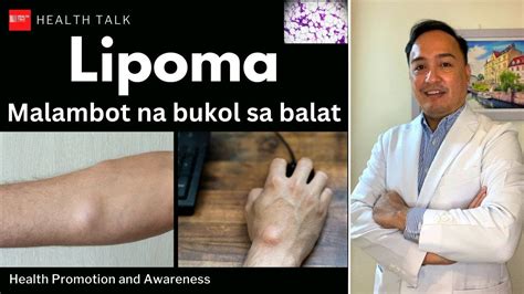 Lipoma Malambot Na Bukol Sa Ilalim Ng Balat Ano Ang Dapat Gawin Youtube