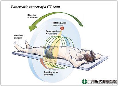 Diagnosis Kanker Pankreas Rumah Sakit Tumor Modern Guangzhou China