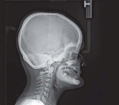 Lateral Cephalogram Showing Midfacial Hypoplasia With Concave Profile