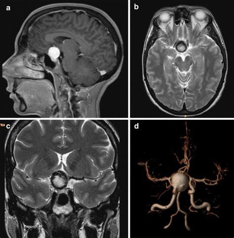 Brain Aneurysm Mri With Contrast : To obtain an accurate mri image of ...