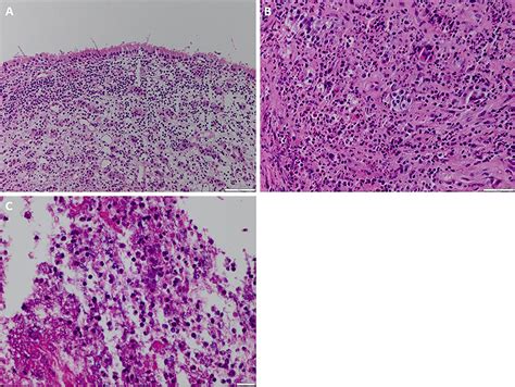 Rathke’s cleft cyst presenting with recurrent aseptic meningitis and