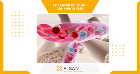 Les cancers du sang symptômes et traitement