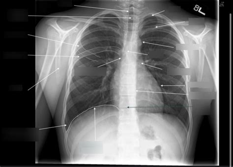 PA Chest X Ray Labeling Diagram Quizlet