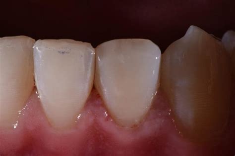 Enamel Dentin Fracture