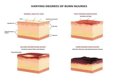 Burn Treatment and Degrees of Burn | UPMC HealthBeat