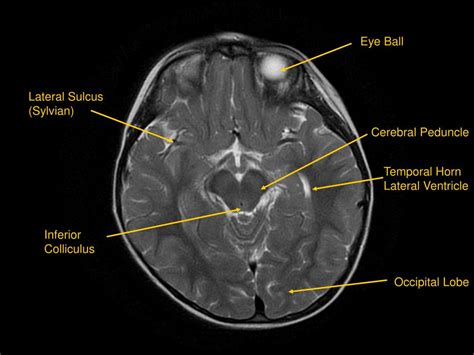 Inferior Colliculus Mri