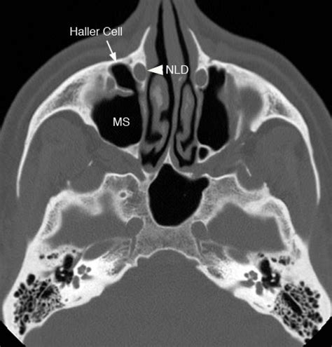 Haller Cell Radiology / The Preoperative Sinus CT: Avoiding a "CLOSE ...