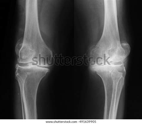 Bilateral Osteoarthritis Knee Joint Xray Image Stock Photo Edit Now