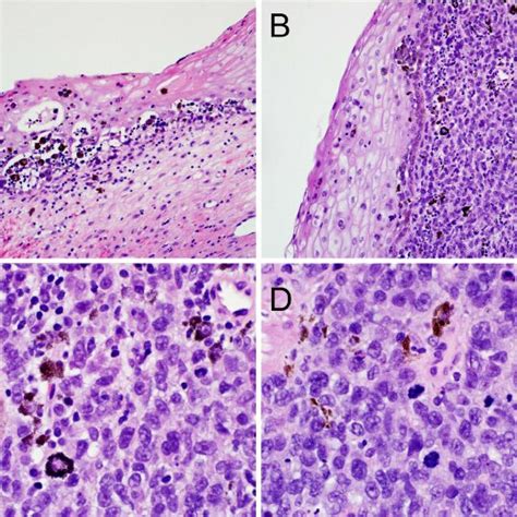 PDF Primary Malignant Melanoma Of The Female Urethra A Radiologic