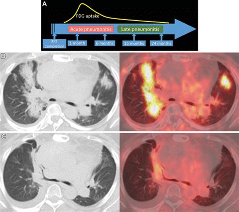 Side Effects Of Oncologic Treatment In The Chest Manifestations At FDG