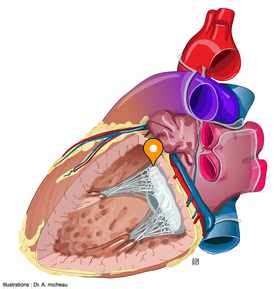 Anterior leaflet of left atrioventricular valve - e-Anatomy - IMAIOS