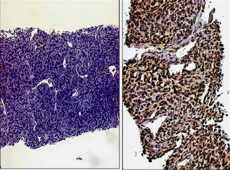 Case Of A Monophasic Synovial Sarcoma Diagnosed On A Small Core Biopsy