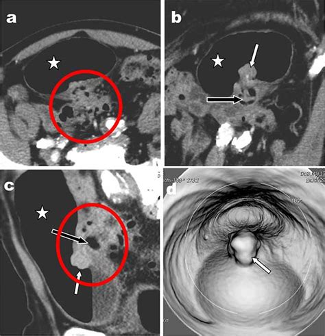 Intravesical Protrusion Of A Pedunculated Colonic Polyp Through A