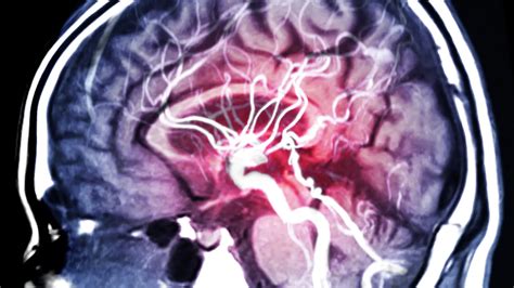 Samuel Gandy neurólogo El lecanemab es el primer fármaco contra el