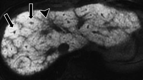 Imaging Findings Of Congestive Hepatopathy Radiographics