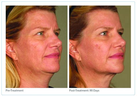 Fairfax Plastic Surgery Loudoun Ultherapy Before After Photos