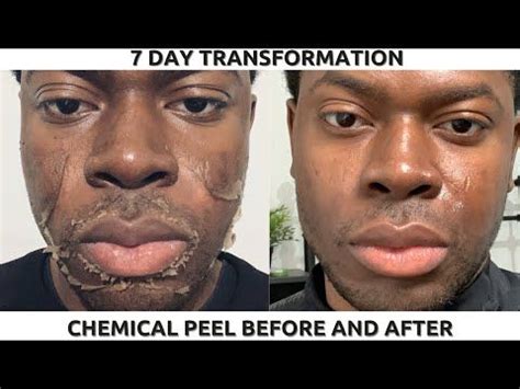 Chemical Peels Beverly Hills Truesdale Facial Plastic