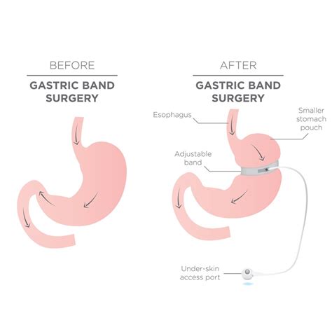 Gastric Band For Weight Loss | Bariatric Clinic Singapore | By G &L ...