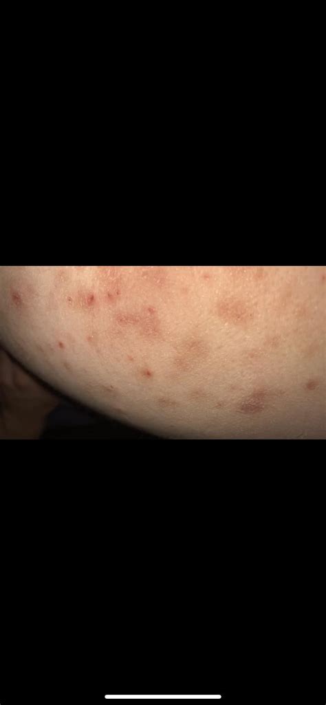 Is this scabies? I have the little black dots everywhere, hard to get a ...